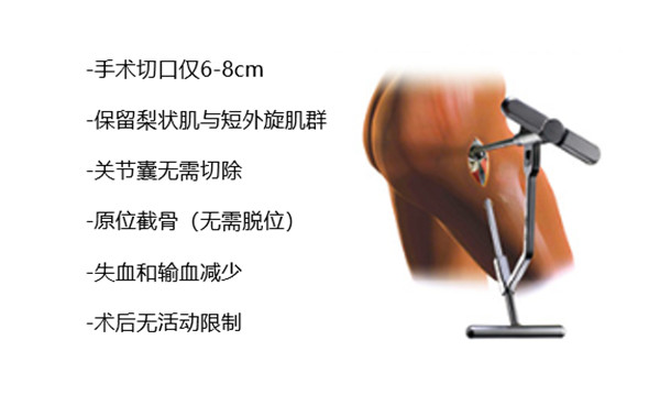 Superpath Small Incision 宝鸡第三医院-SuperPATH入路,7cm,30分钟——股骨颈骨折 宝三医的选择